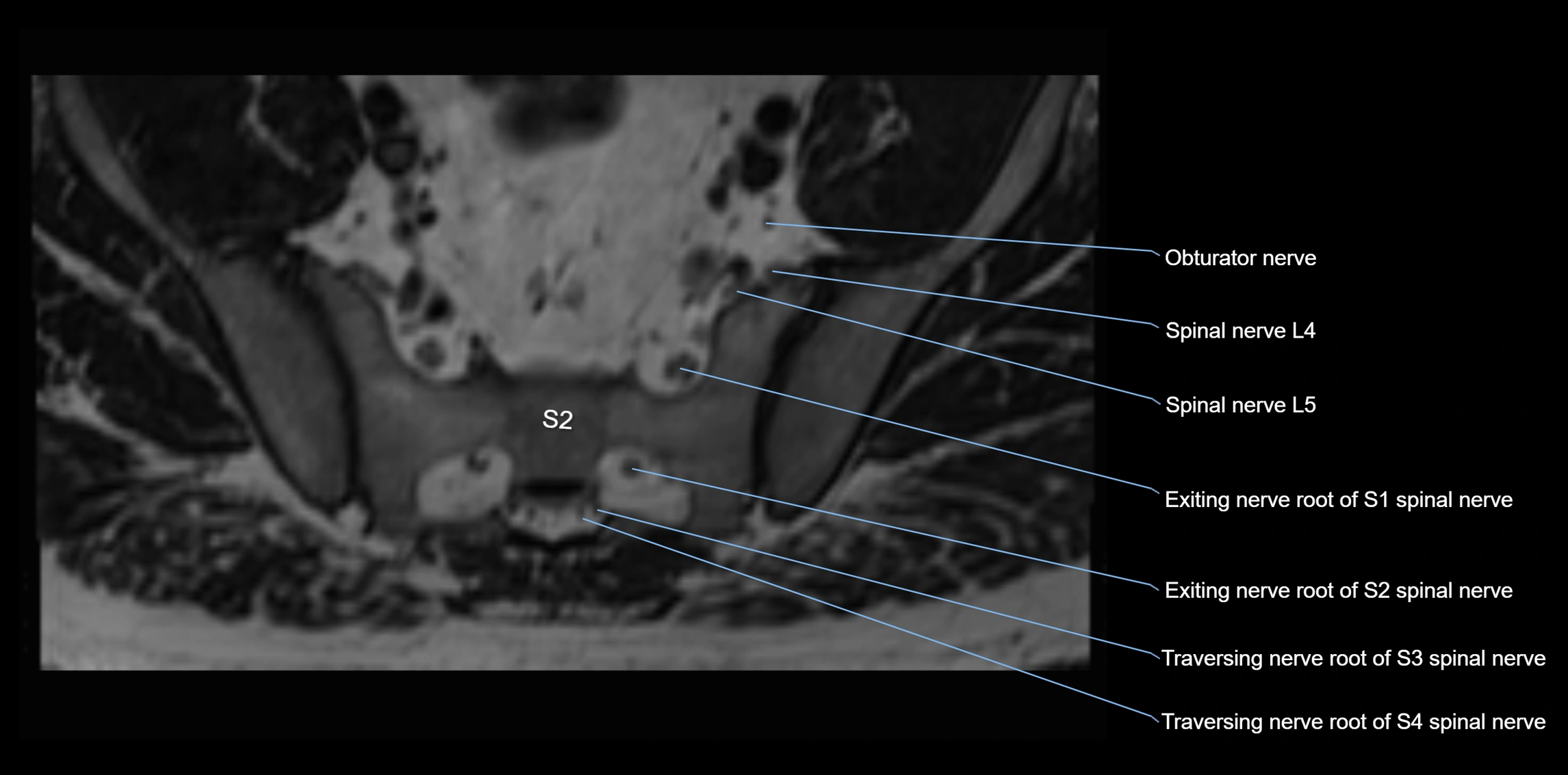 MR lumbosacral plexus axial cross sectional anatomy 3T  radiology  image-img-1008001-00084.webp